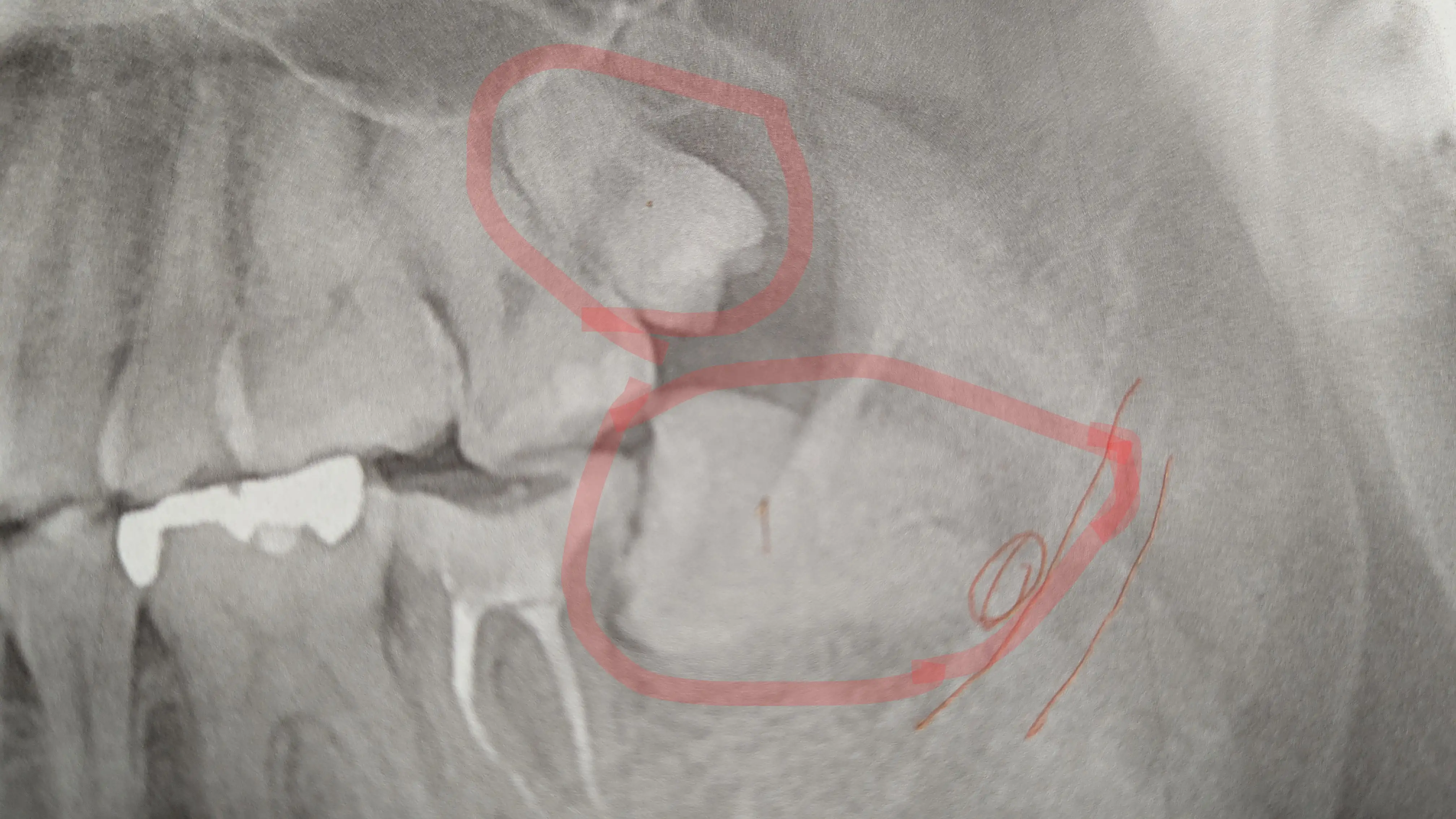 親知らずのレントゲンの写真